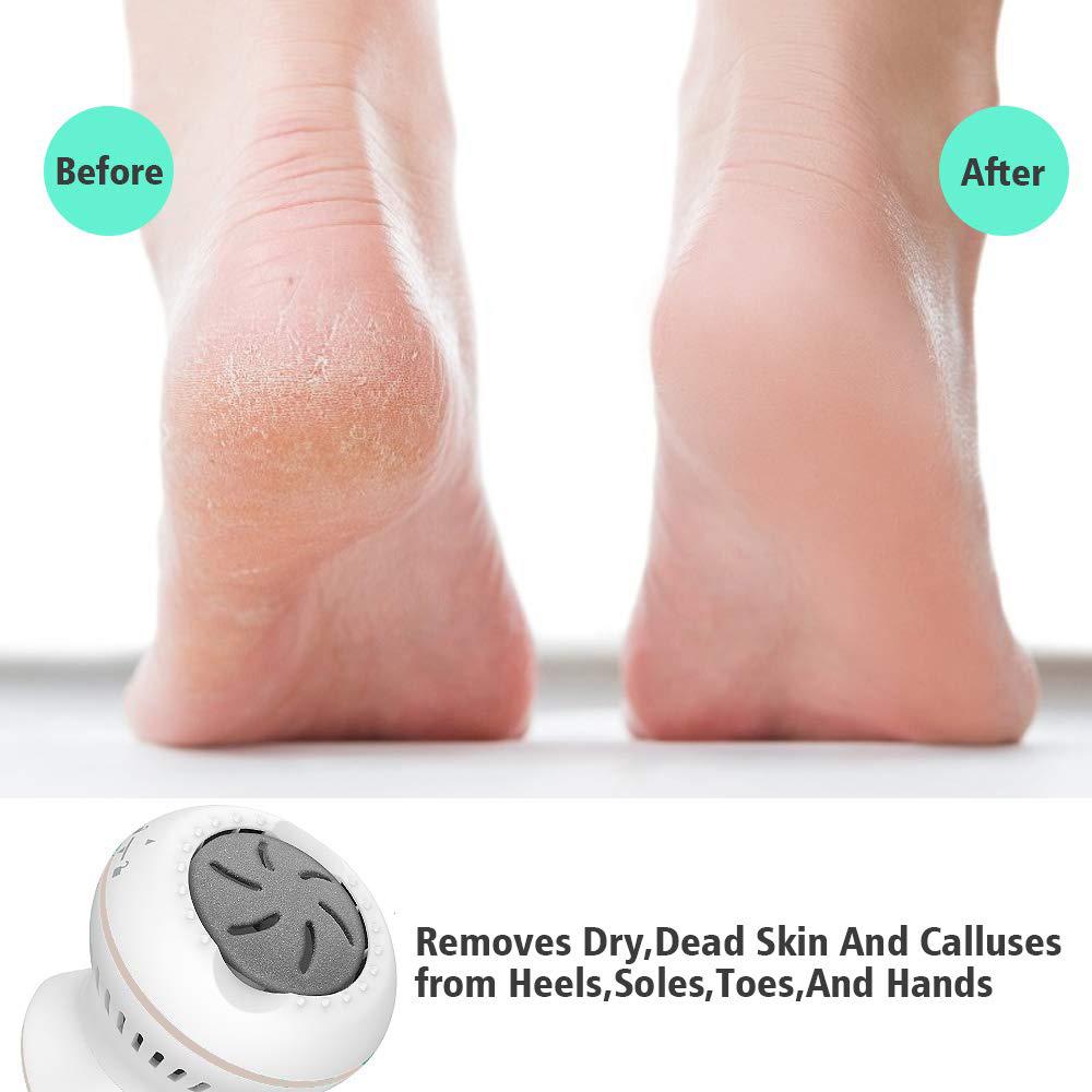 Igia Callus Remover - Retail Therapy Online